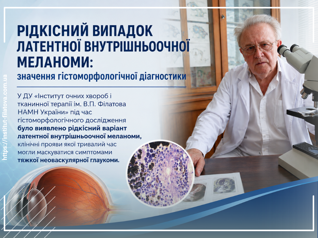 РІДКІСНИЙ ВИПАДОК ЛАТЕНТНОЇ ВНУТРІШНЬООЧНОЇ МЕЛАНОМИ: ЗНАЧЕННЯ ГІСТОМОРФОЛОГІЧНОЇ ДІАГНОСТИКИ